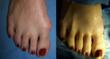 bunion surgery los angeles before and after la peer surgery center